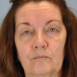 Eyelid Surgery Before & After Patient #11518
