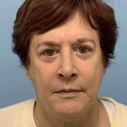 Eyelid Surgery Before & After Patient #11532