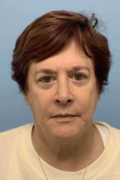 Eyelid Surgery Before & After Patient #11532