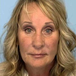 Eyelid Surgery Before & After Patient #11572