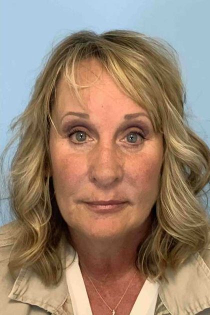 Eyelid Surgery Before & After Patient #11572