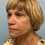 Eyelid Surgery Before & After Patient #11617