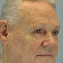 Eyelid Surgery Before & After Patient #11655