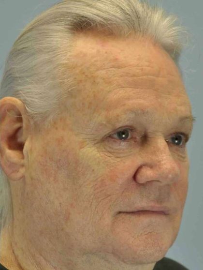 Eyelid Surgery Before & After Patient #11655