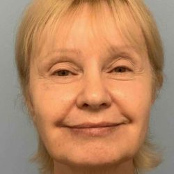 Eyelid Surgery Before & After Patient #11668