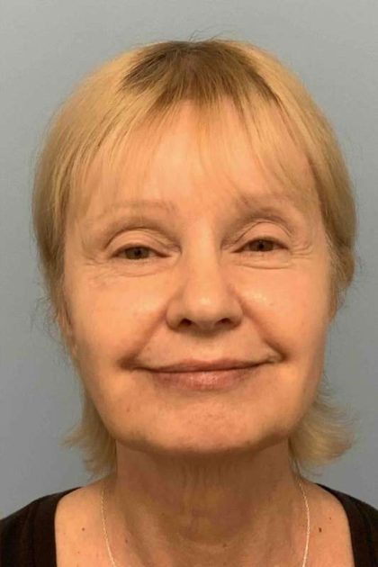 Eyelid Surgery Before & After Patient #11668