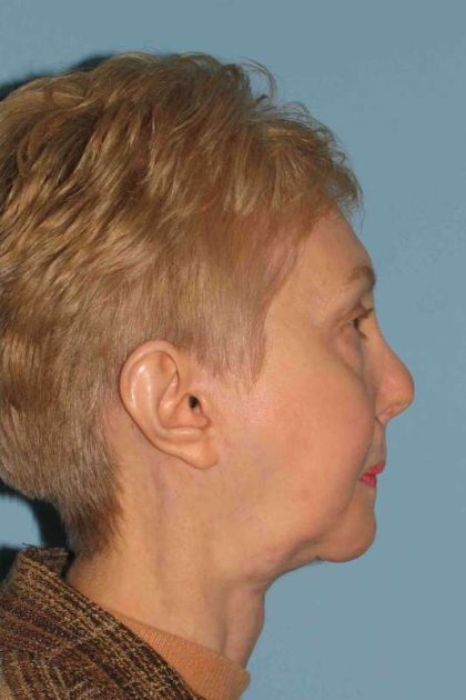 Chin Surgery Before & After Patient #11687
