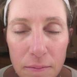 Chemical Peels Before & After Patient #11701