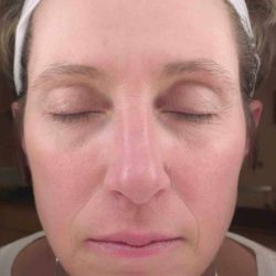Chemical Peels Before & After Patient #11701