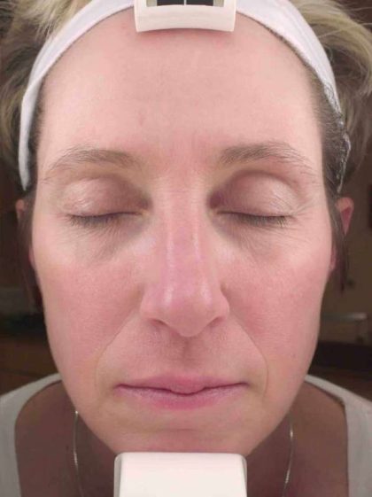 Chemical Peels Before & After Patient #11701