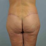 Buttocks Before & After Patient #11718