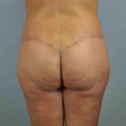 Buttocks Before & After Patient #11718