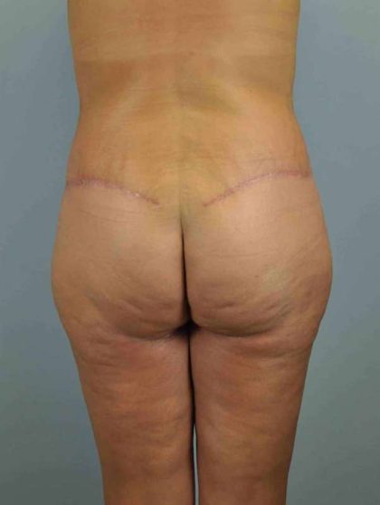 Buttocks Before & After Patient #11718