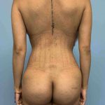 Buttocks Before & After Patient #11728