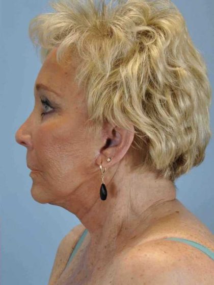Brow Lift Before & After Patient #11742