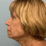 Brow Lift Before & After Patient #11779