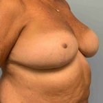 Breast Reduction Before & After Patient #11838