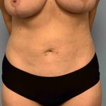 Breast Reduction Before & After Patient #11847