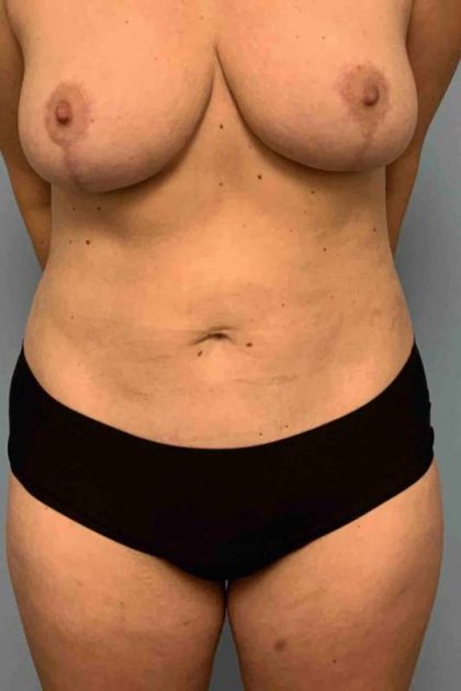 Breast Reduction Before & After Patient #11847