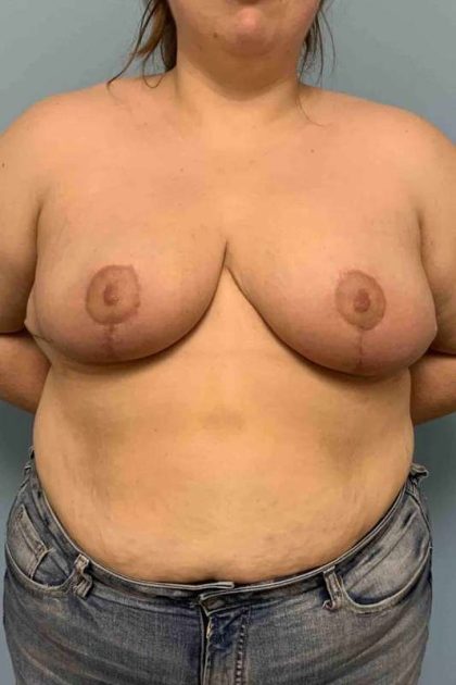 Breast Reduction Before & After Patient #11854