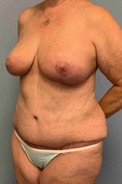 Breast Reduction Before & After Patient #11870
