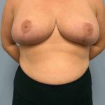 Breast Reduction Before & After Patient #11877