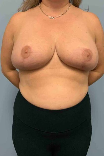 Breast Reduction Before & After Patient #11877
