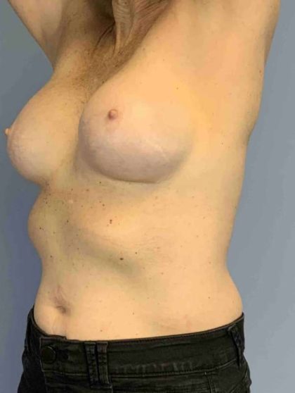 Breast Reconstruction Before & After Patient #11884