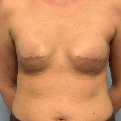 Breast Reconstruction Before & After Patient #11894