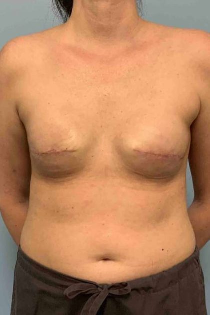 Breast Reconstruction Before & After Patient #11894