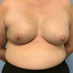 Breast Reconstruction Before & After Patient #11901