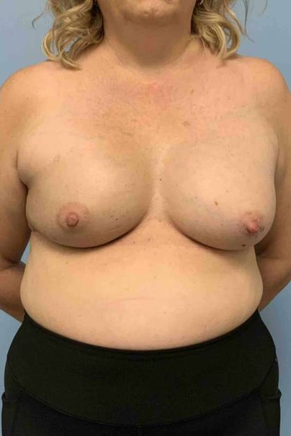 Breast Reconstruction Before & After Patient #11901