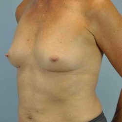 Breast Reconstruction Before & After Patient #11908