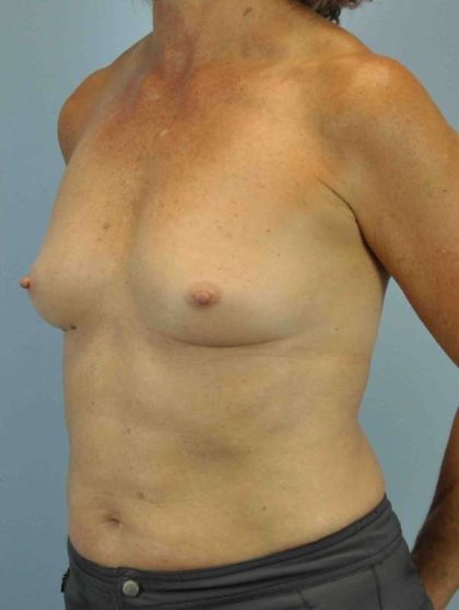 Breast Reconstruction Before & After Patient #11908
