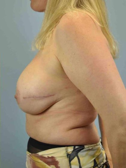 Breast Reconstruction Before & After Patient #11919