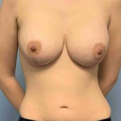 Breast Lift Before & After Patient #11964