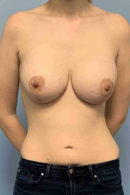 Breast Lift Before & After Patient #11964