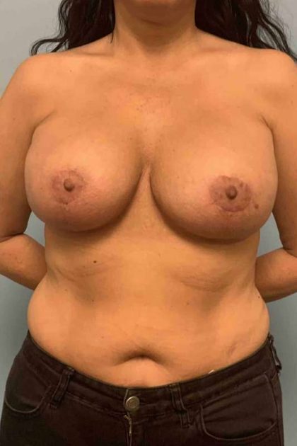 Breast Lift Before & After Patient #11980
