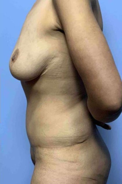 Breast Lift Before & After Patient #11994