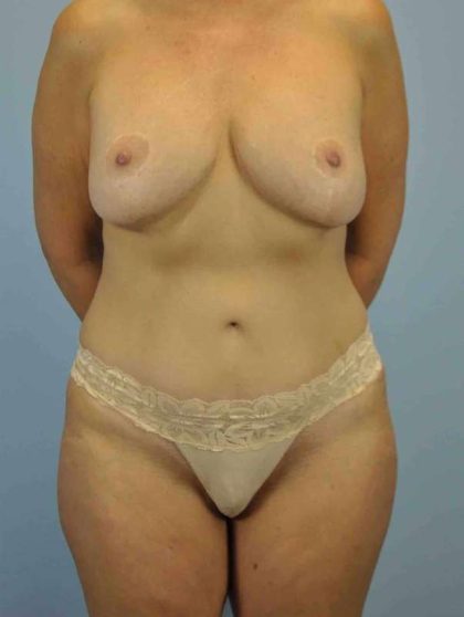Breast Lift Before & After Patient #12001