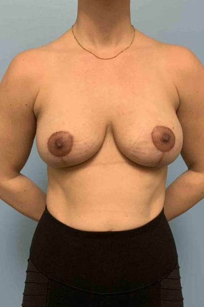 Breast Lift Before & After Patient #12042