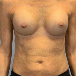 Breast Augmentation Before & After Patient #12049
