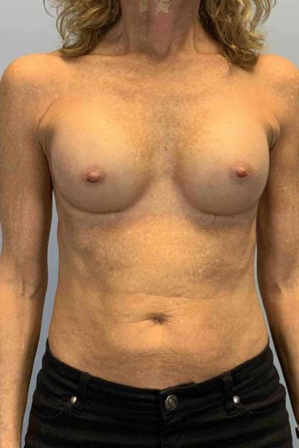Breast Augmentation Before & After Patient #12049