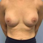 Breast Augmentation Before & After Patient #12056