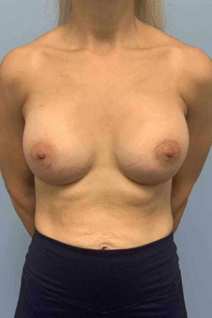 Breast Augmentation Before & After Patient #12056