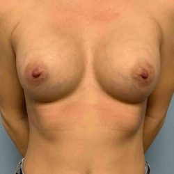 Breast Augmentation Before & After Patient #12063