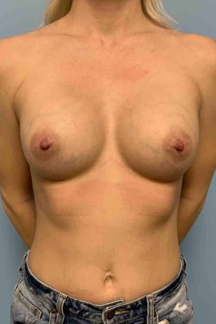 Breast Augmentation Before & After Patient #12063