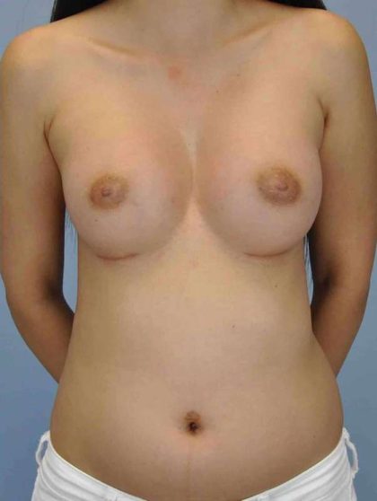 Breast Augmentation Before & After Patient #12077