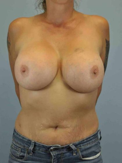 Breast Augmentation Before & After Patient #12101