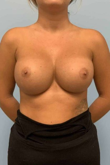 Breast Augmentation Before & After Patient #12120